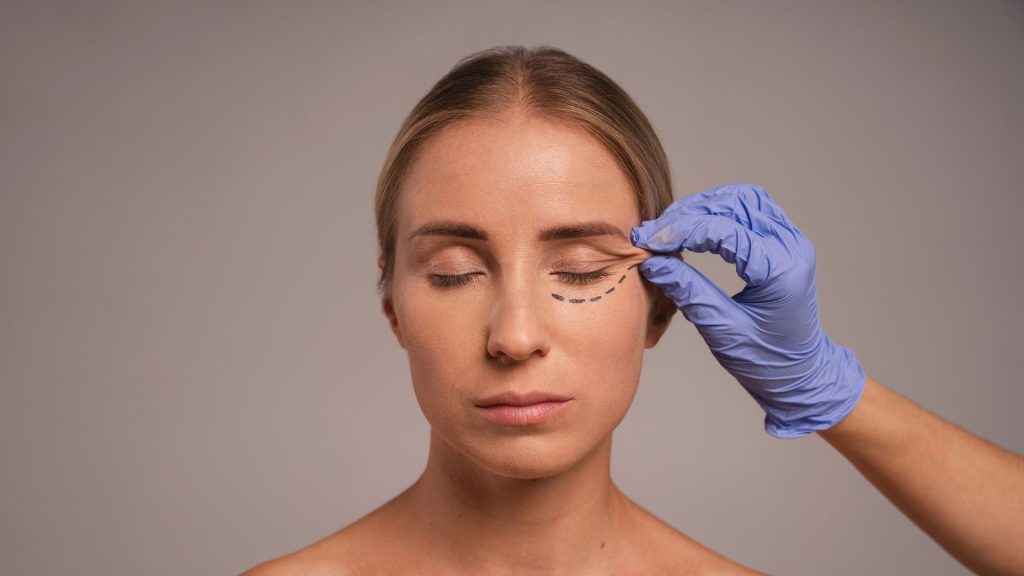 blefaroplastia estética