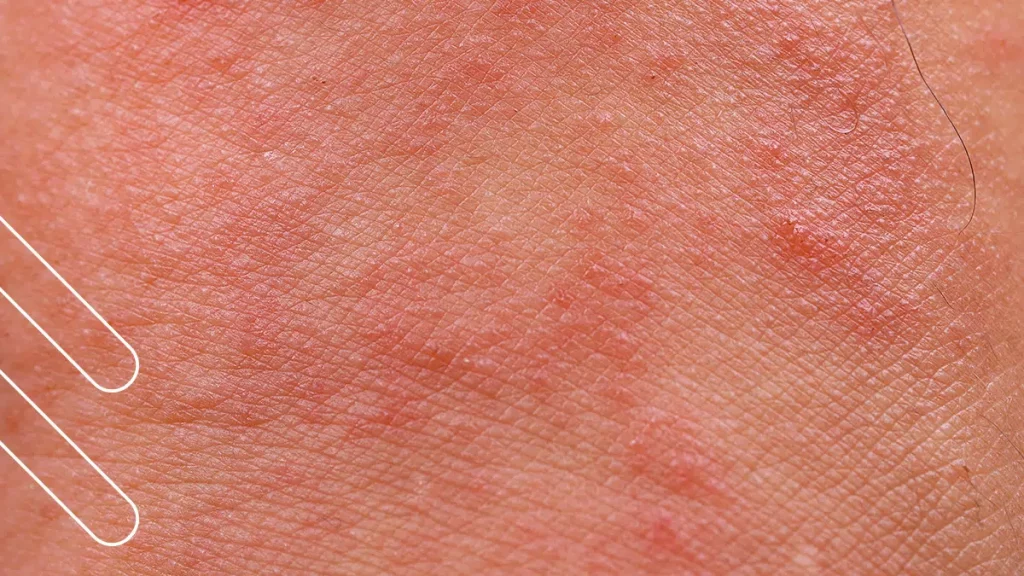 rosacea cutanea, ojos