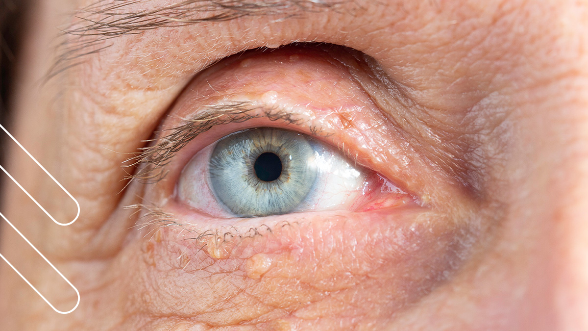 Tratamiento DE Xantelasmas EN Bilbao: ELIMINA Las Bolsas Amarillas ALREDEDOR DE LOS OJOS