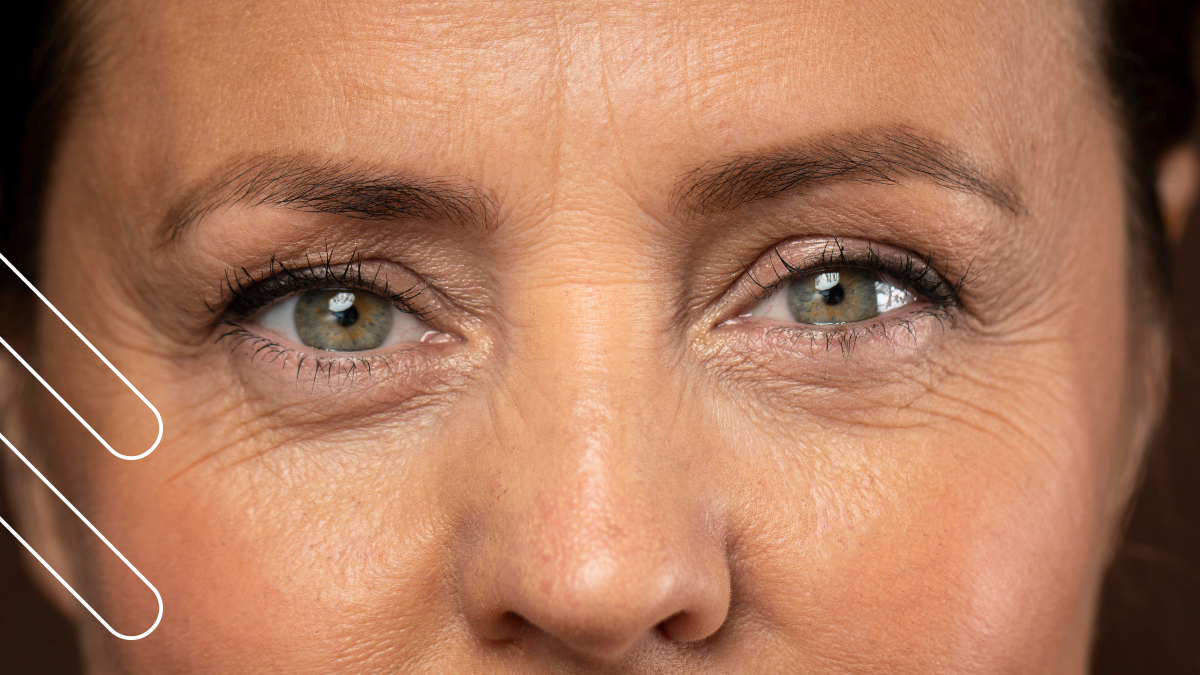 Tratamiento patas de gallo en Bilbao: La clave médica para rejuvenecer tu mirada