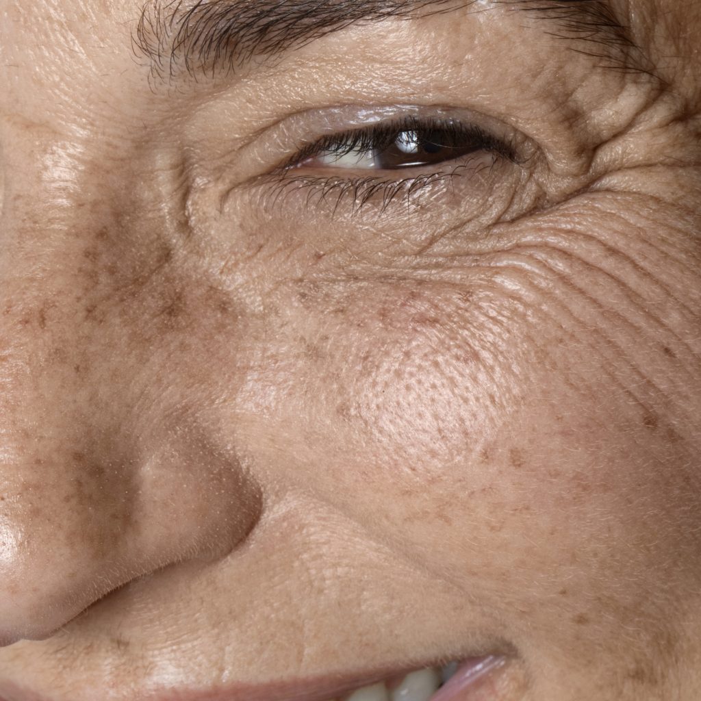 Tratamiento patas de gallo en Bilbao