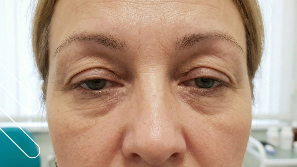 cirugía de párpados