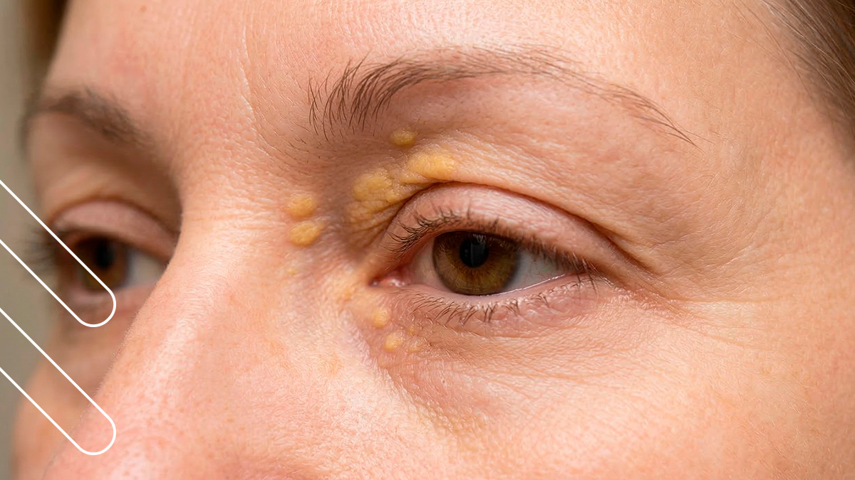 xantelasmas en el párpado