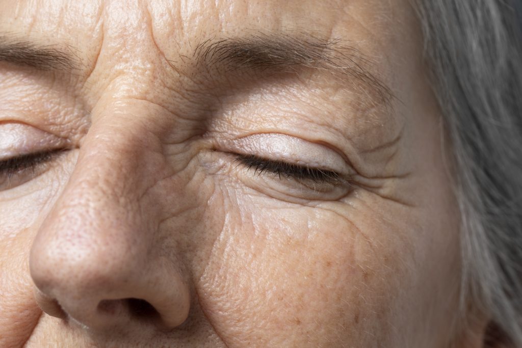 cicatriz tras una blefaroplastia
